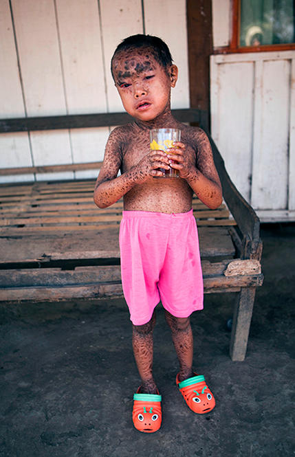 Rohim Revelation from Indonesia has the skin condition Lamellar Ichthyosis