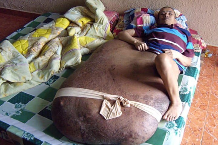 Hai's rare condition is called neurofibromatosis.
