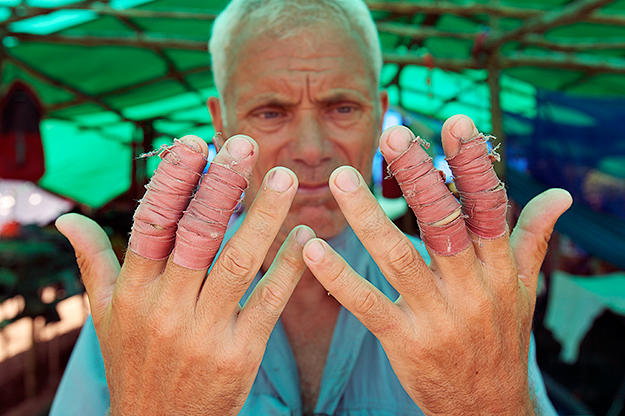 Jeremy with his wrapped fingers to fish.