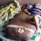 Hai's rare condition is called neurofibromatosis.