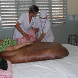 Because Hai's condition is so severe, he could not travel outside of Vietnam for this incredibly risky operation.